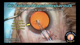 CataractCoach™1710: this radialized capsulorhexis is stuck