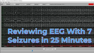 EEG with 7 seizures in 25 minutes
