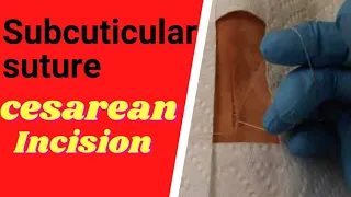 subcuticular suture-cesarean suture-plastic suture-subcuticular  suture cesarean incision