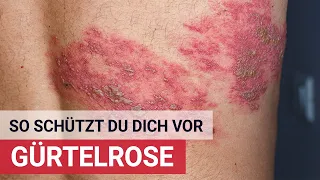 So schützt du dich vor Gürtelrose!