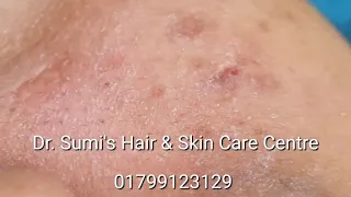 Acne treatment || Salipeel with Comedon extraction || Acne || Dr. Ummay Habiba Sumi || 01799123129