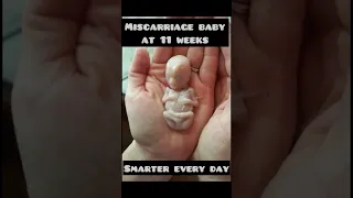 Miscarriage baby at 11 weeks | His mom took picture to remember it forever #baby #maa #medical