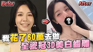 【愛里】我花60萬做了「全瓷冠3D美白齒雕」