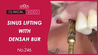 Implant placement & Sinus lifting using Densah bur - [Dr. Kim Yongjin]
