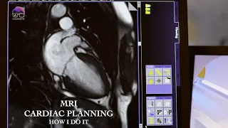 MRI CARDIAC PLANNING, HOW I DO IT