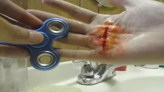 Fidget Spinner Vs Hand (Legit Had To Get Stitches)