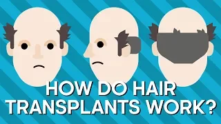 How Do Hair Transplants Work? | Earth Science