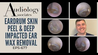 EARDRUM SKIN PEEL & DEEP IMPACTED EAR WAX REMOVAL - EP677