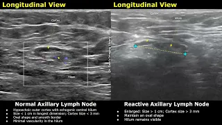 Axillary Lymph Nodes Ultrasound Normal Vs Abnormal Images With Doppler | Reactive & Malignant Nodes