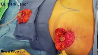 Dr. Mark Jabor - Breast Reduction / Mastopexy in El Paso, TX
