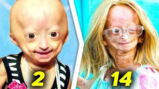 Who Is The Girl Who Grows Old Fast? | Adalia Rose Williams