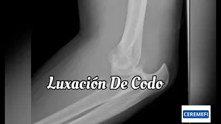 Luxación de codo (Puyol)