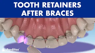 TOOTH RETAINERS after braces - How to PREVENT MOVING teeth after orthodontics ©