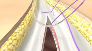 Abdominal Wall Closure BBraun