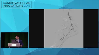 CVI2018 Session: I am proud of this CLI - Subasit Acharji, MD