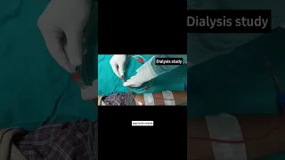 Cannulation of AVF, Connecting patient to dialysis machine