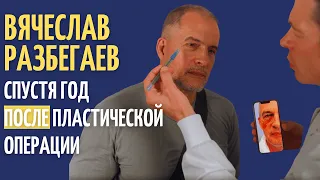 Вячеслав Разбегаев: отзывы о липофилинге и блефаропластике спустя год после операции!