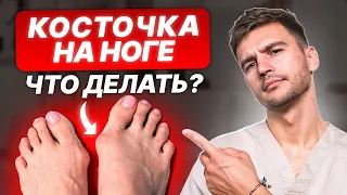 Вальгус влияет на то, как ты выглядишь! Как избавиться от косточки на стопе?