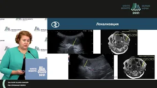 Роль современных УЗ методов  при 1ой  диагностике образований больших слюнных желез. Помощь хирургу