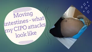 How my CIPO acute attacks look and feel - visible peristalsis | CIPO motility disorder
