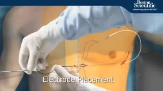 S-ICD Implant Procedure Animation