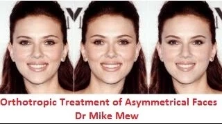 Orthotropics Treatment of Asymmetrical/ Disproportionate/ Uneven Faces by Dr MIke Mew