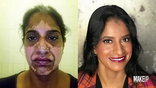 Vitiligo Before & After | Makeup by Ryno