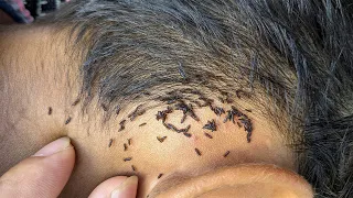 There are a lot lice hide under short hair - Remove thousand lice from head