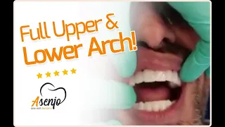 ASENJO One Visit Dentistry in Punta Cana - FULL UPPER AND LOWER GRAPHENE ARCH - IHDE IMPLANT