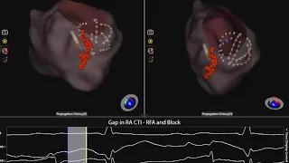 Cavotricuspid Flutter Ablation using AcQMap®