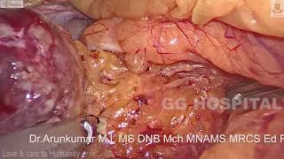 Laparoscopic spleen preserving distal pancreatectomy- kimura technique