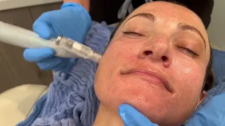 PRP + Microneedling with the new Eclipse Micropen EVO