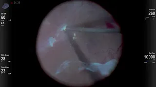 Segmentation Technique to Repair a Diabetic Tractional Retinal Detachment