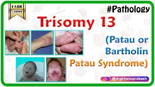 Trisomy 13 (Patau or Bartholin-Patau syndrome) - Causes , Diagnosis , Treatment