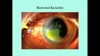 Keratitis - CRASH! Medical Review Series