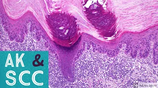 Squamous Cell Carcinoma & Actinic Keratosis 101...Dermpath Basics & Beyond