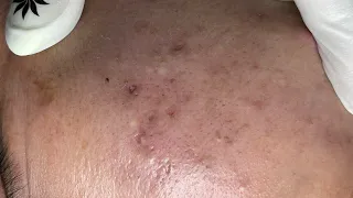 Relaxing Acne Treatment #189(Linh My Dang)P1
