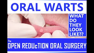 WHAT do ORAL WARTS LOOK LIKE??? HOW to IDENTIFY a MOUTH WART | HPV PAPILLOMA