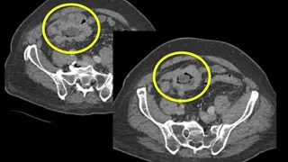 CT Evaluation of Small Bowel Obstruction Part 3
