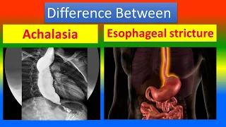Difference Between Achalasia and Esophageal Stricture