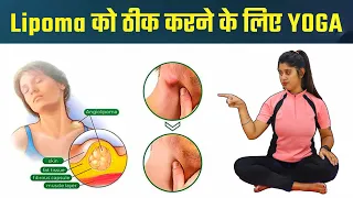 शरीर में लिपोमा गांठ को योग से ठीक करें | How to Cure Lipoma by Yoga Exercise | @Yogawale