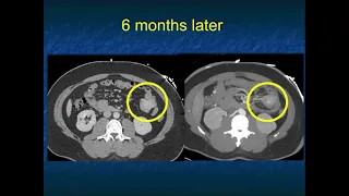 CT Evaluation of Small Bowel Tumors: Detection & Classification - Part 1