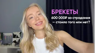 МНЕ ПОСТАВИЛИ БРЕКЕТЫ 🦷🪄🎀 Неделя с брекетами. Цены в Москве