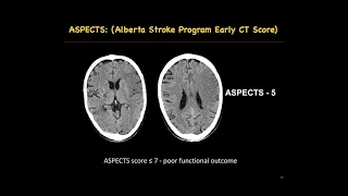 Workshop on Stroke Imaging basics: Prof. Ajay Garg