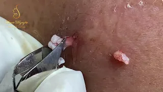 TREATMENT CYST with SAC REMOVAL (102) | Loan Nguyen