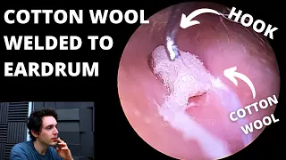 Cotton Wool Welded To Eardrums (Why Don't We Numb Up Patients?)