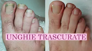 Pedicure: unghie trascurate, incarnite e onicolisi