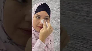 Rinoplastikadan keyingi 13-kun. blefaroplastika operatsiyadan keyin