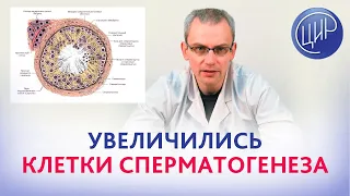 Клетки сперматогенеза после болезни мужа. Отвечает врач андролог ЦИР, Живулько Андрей Романович.