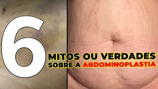 6 MITOS OU VERDADES SOBRE A ABDOMINOPLASTIA - CIRURGIA PLASTICA